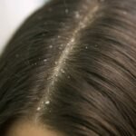 Dandruff with Colored Hair