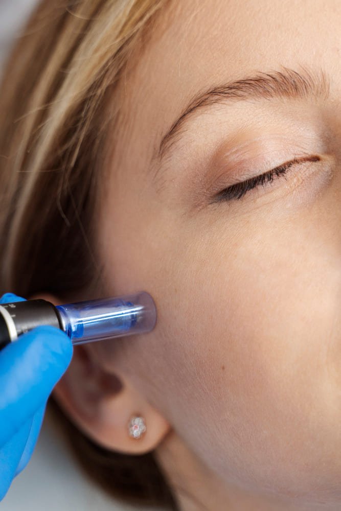 skin needling