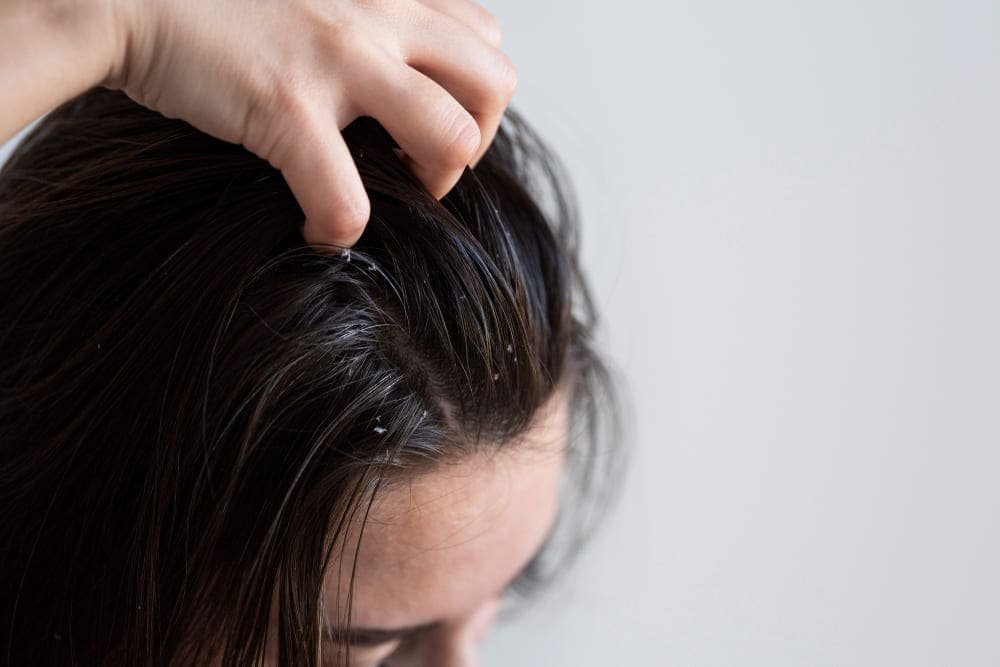 hair dandruff 